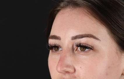 Brow Lift Before & After Patient #4766