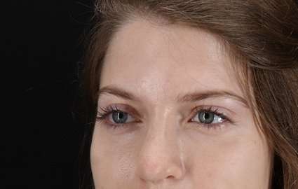 Brow Lift Before & After Patient #4777
