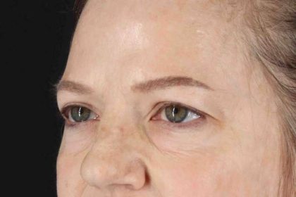 Brow Lift Before & After Patient #4854