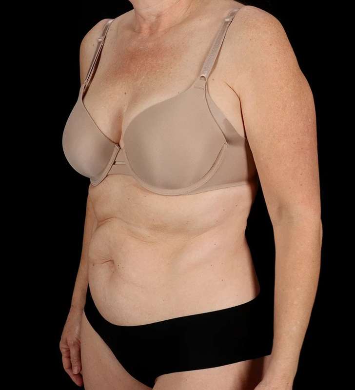 Abdominoplasty (Tummy Tuck) Before & After Patient #1029