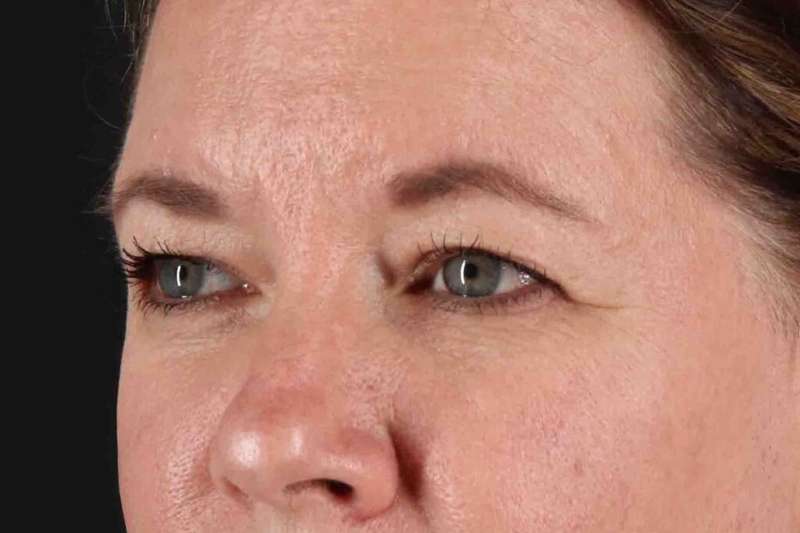 Brow Lift Before & After Patient #4865