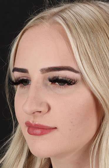 Brow Lift Before & After Patient #4876