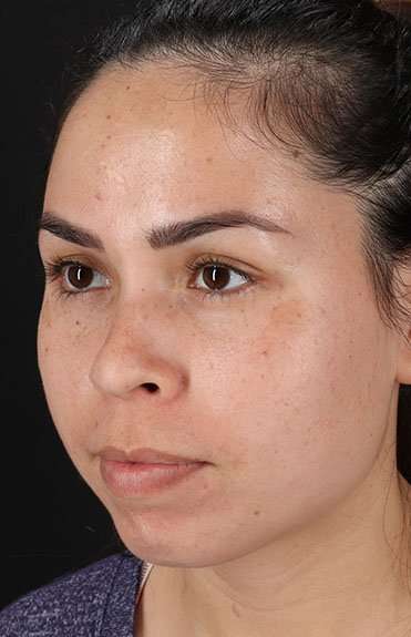 Cosmetic Injectables Before & After Patient #4990