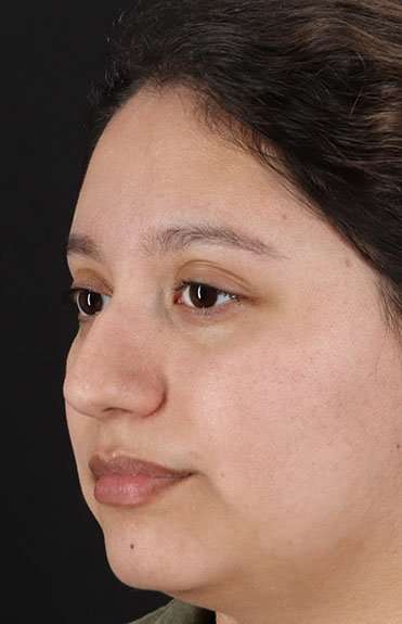 Cosmetic Injectables Before & After Patient #5001