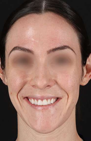 Cosmetic Injectables Before & After Patient #5016