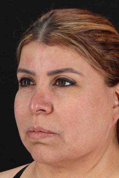 Earlobe Repair Before & After Patient #5064