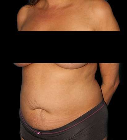 Abdominoplasty (Tummy Tuck) Before & After Patient #590
