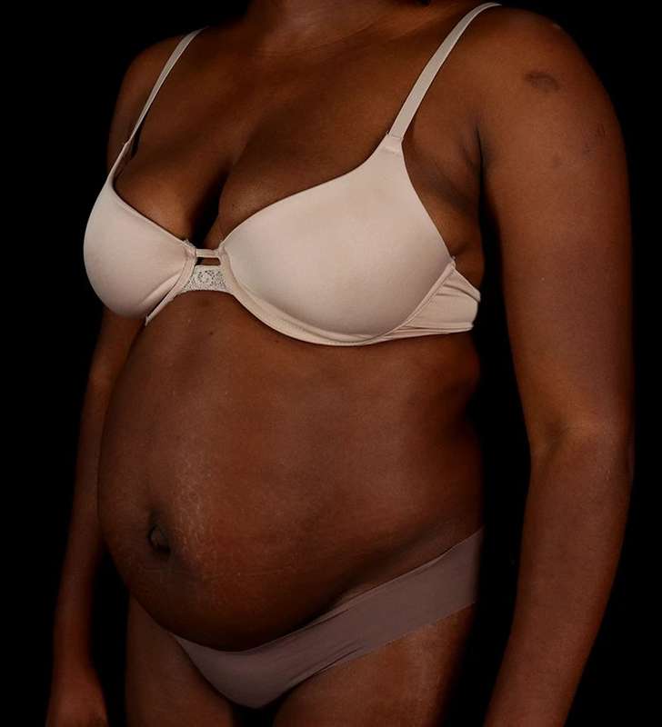 Abdominoplasty (Tummy Tuck) Before & After Patient #1045