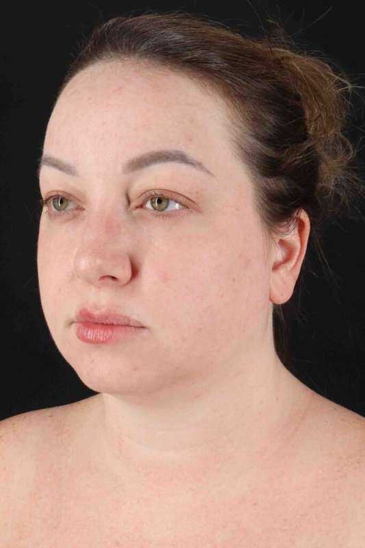 Facelift Before & After Patient #5097