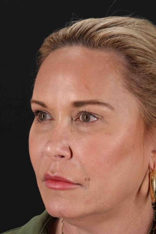 Facelift Before & After Patient #5119