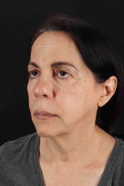 Facelift Before & After Patient #5141