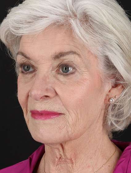 Facelift Before & After Patient #5174
