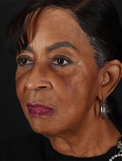 Facelift Before & After Patient #5196