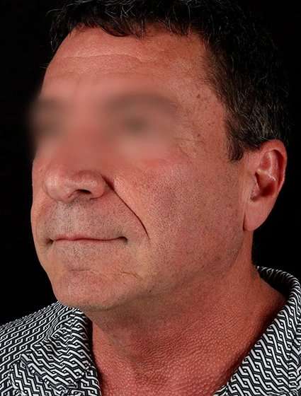 Facelift Before & After Patient #5207