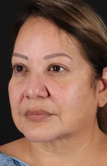 Facelift Before & After Patient #5218