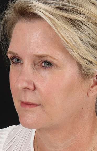 Facelift Before & After Patient #5229