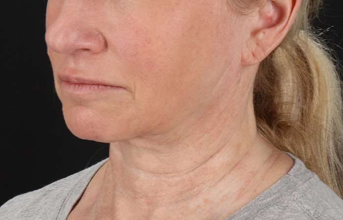 Facelift Before & After Patient #5240