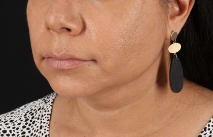 Facelift Before & After Patient #5251