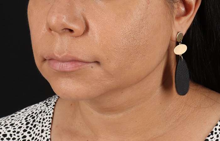Facelift Before & After Patient #5251