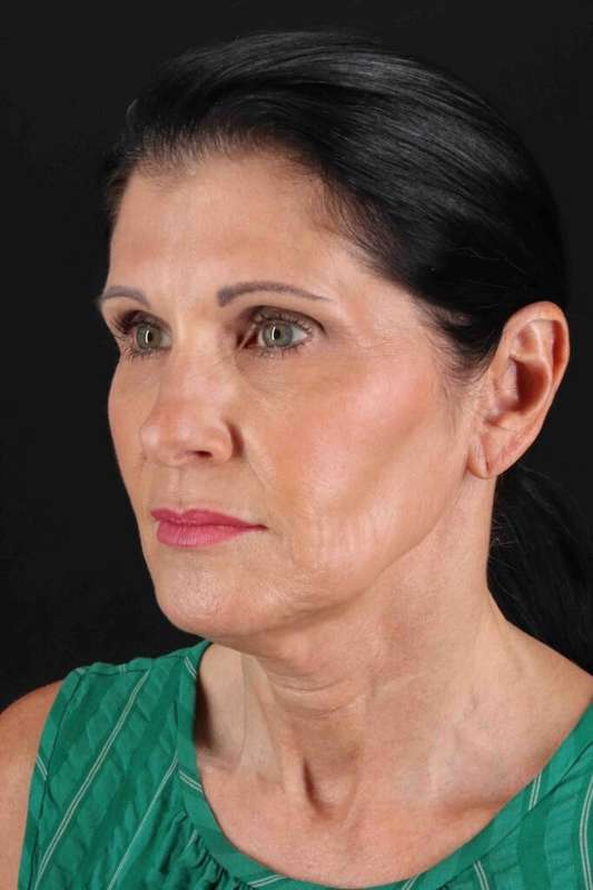 Facelift Before & After Patient #5262