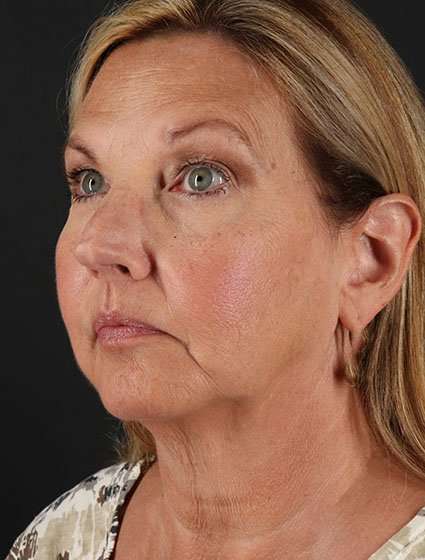 Facelift Before & After Patient #5348