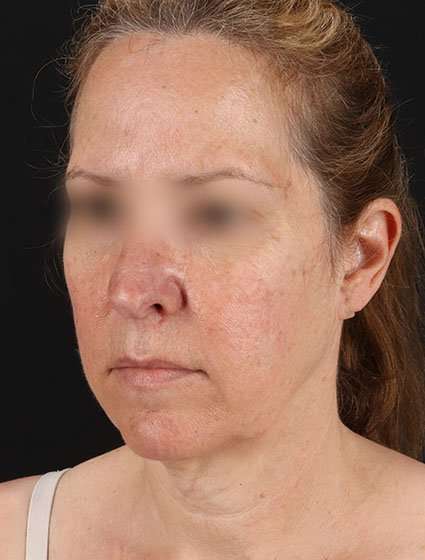 Facelift Before & After Patient #5359