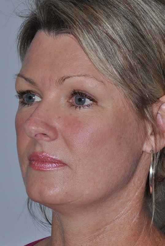 Facelift Before & After Patient #5385