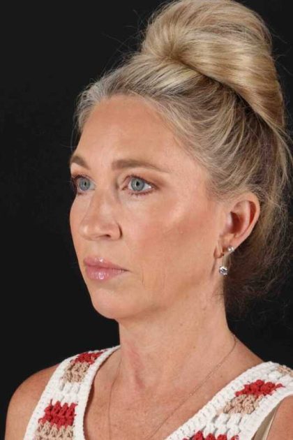 Facelift Before & After Patient #5488