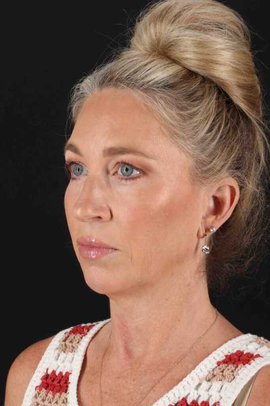 Facelift Before & After Patient #5488