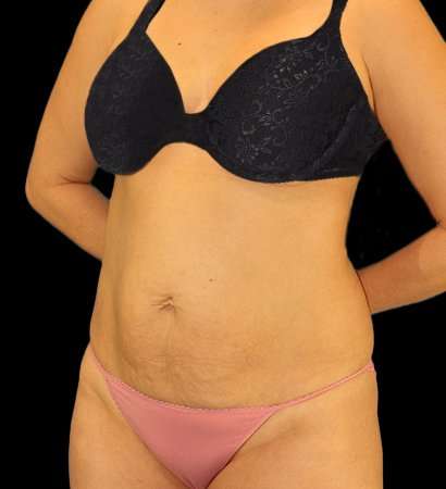 Abdominoplasty (Tummy Tuck) Before & After Patient #1083