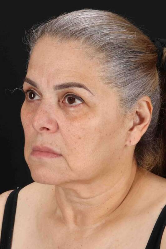 Facelift Before & After Patient #5510