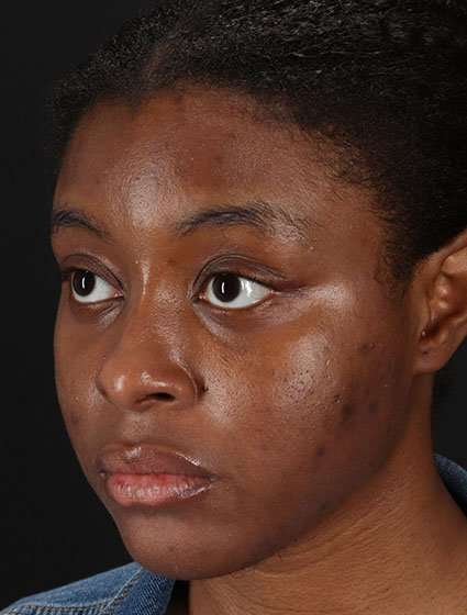 Chemical Peels Before & After Patient #5568