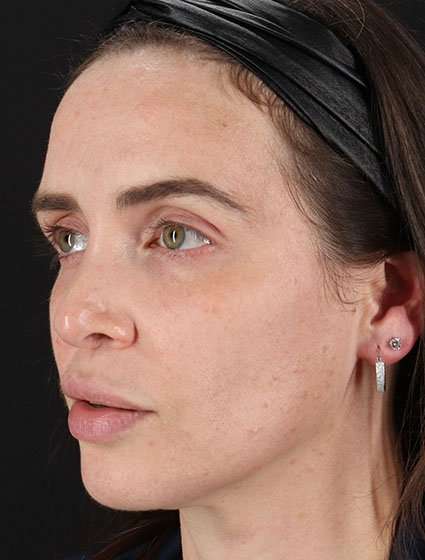 Chemical Peels Before & After Patient #5579