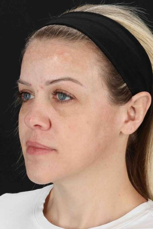 Chemical Peels Before & After Patient #5601