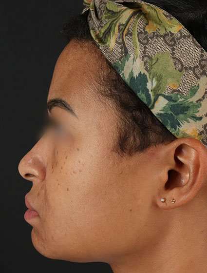 Chemical Peels Before & After Patient #5610
