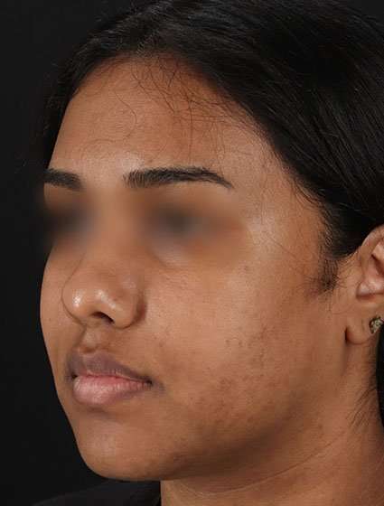 Chemical Peels Before & After Patient #5621