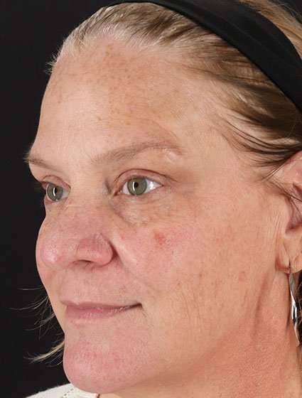 Chemical Peels Before & After Patient #5632