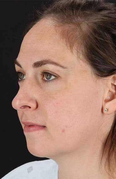 Neck Liposuction Before & After Patient #5687