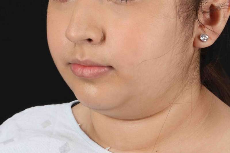 Neck Liposuction Before & After Patient #5698