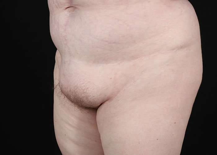 Monsplasty Before & After Patient #1117