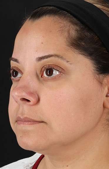 Neck Liposuction Before & After Patient #5720