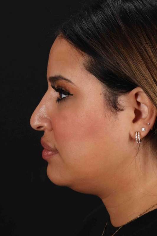 Neck Liposuction Before & After Patient #5762