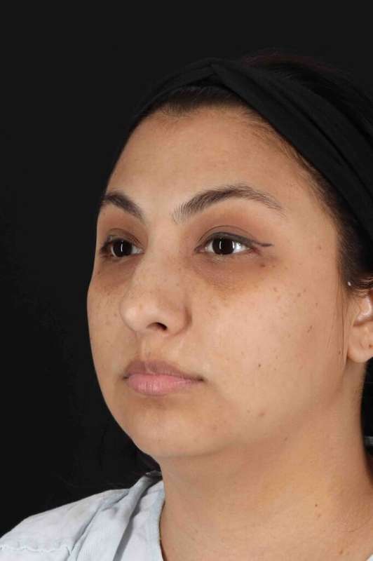 Rhinoplasty Before & After Patient #5826