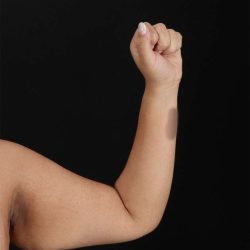Brachioplasty (Arm Lift) Before & After Patient #1150