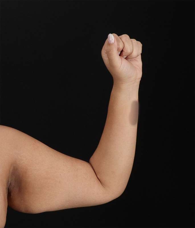 Brachioplasty (Arm Lift) Before & After Patient #1150