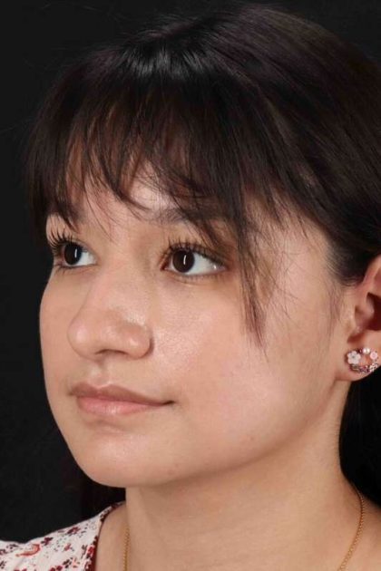 Rhinoplasty Before & After Patient #5837