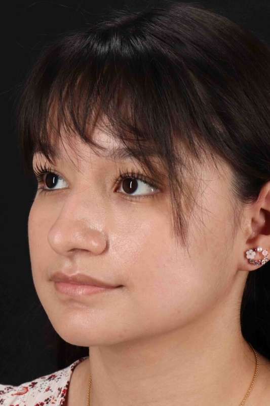 Rhinoplasty Before & After Patient #5837