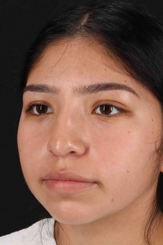 Rhinoplasty Before & After Patient #5848