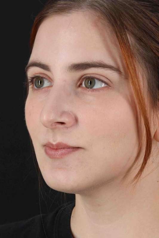 Rhinoplasty Before & After Patient #5859