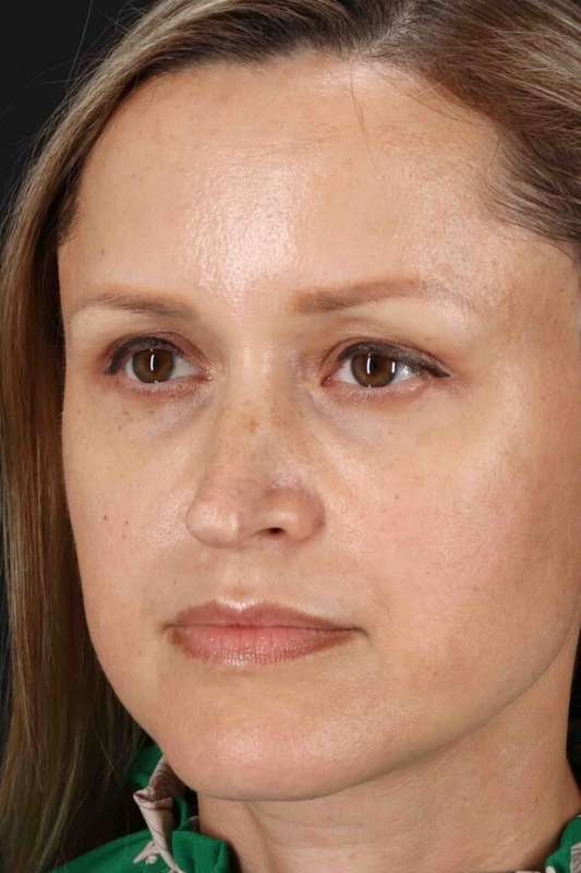 Rhinoplasty Before & After Patient #5870